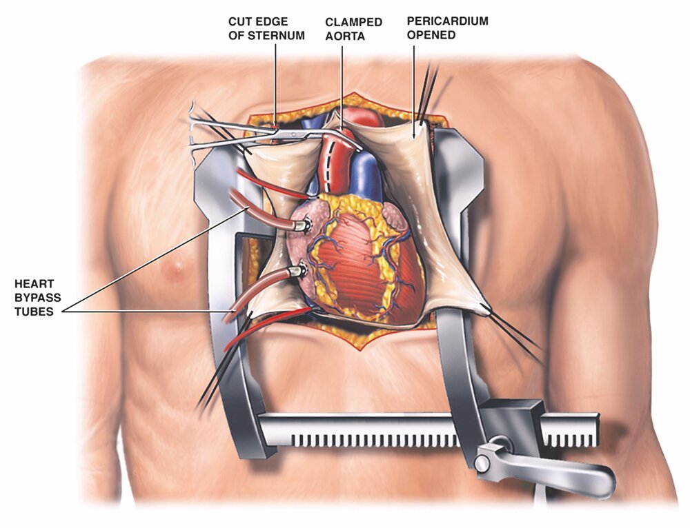 "Medical illustration of open heart bypass surgery showing cut sternum, clamped aorta, pericardium, and bypass tube placement at Infinity Heart Hospital Jabalpur"