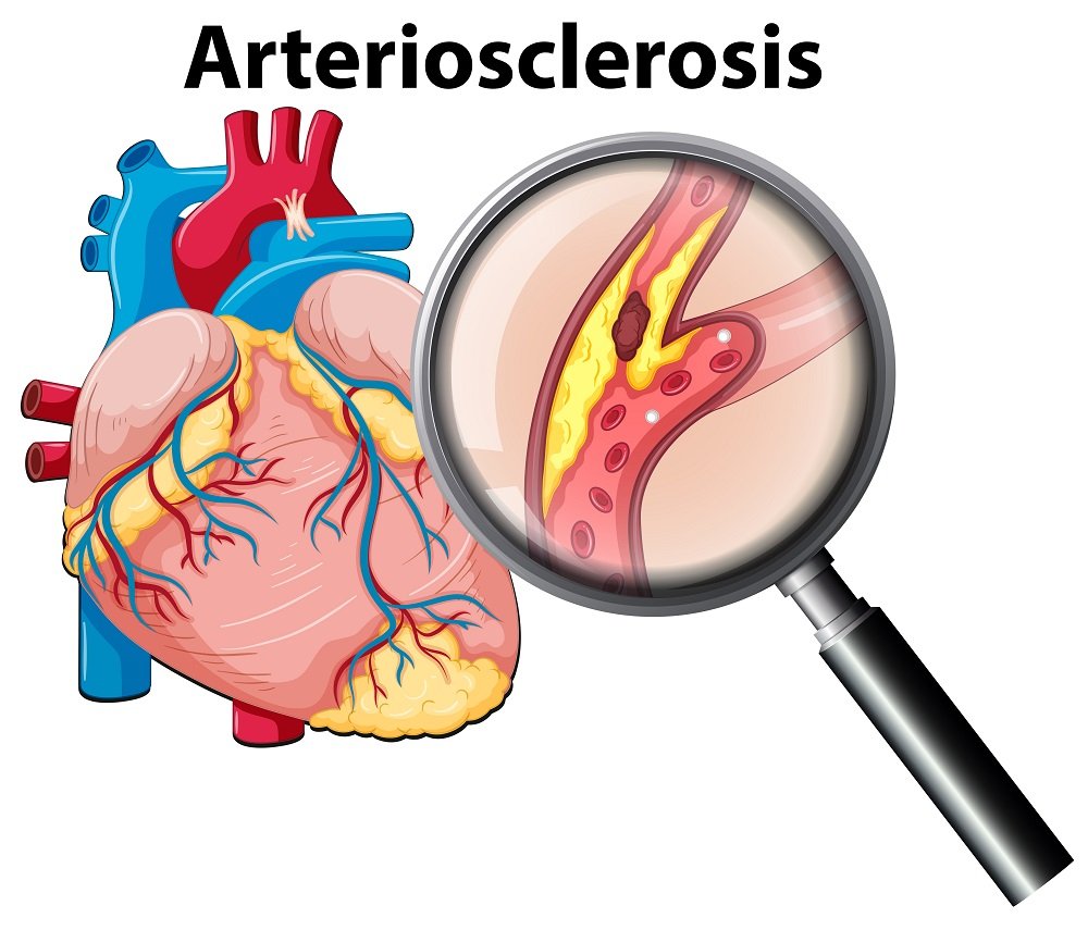"Medical illustration of arteriosclerosis showing heart and blocked artery at Infinity Heart Hospital Jabalpur"