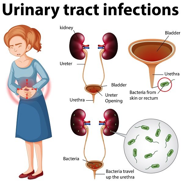 "Urinary tract infection infographic showing painful urination, kidneys, bladder, urethra, and bacteria"
